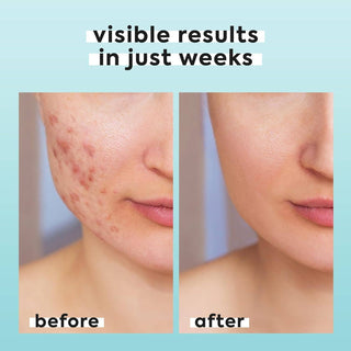 Livaclean 3.4oz Hypochlorous Acid Mist for face & body